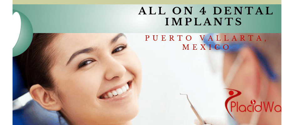 All on 4 Dental Implants in Puerto Vallarta, Mexico